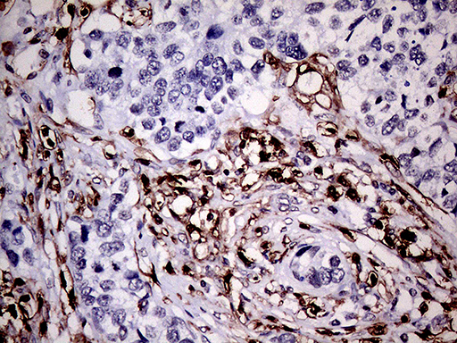 CD45 / LCA Antibody - Immunohistochemical staining of paraffin-embedded Carcinoma of Human lung tissue using anti-CD45RO mouse monoclonal antibody. (Heat-induced epitope retrieval by 1mM EDTA in 10mM Tris buffer. (pH8.0) at 120°C for 3 min. (1:1000)