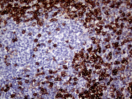 CD45 / LCA Antibody - Immunohistochemical staining of paraffin-embedded Human lymphoma tissue using anti-CD45RO mouse monoclonal antibody. (Heat-induced epitope retrieval by 1mM EDTA in 10mM Tris buffer. (pH8.0) at 120°C for 3 min). (1:1000)