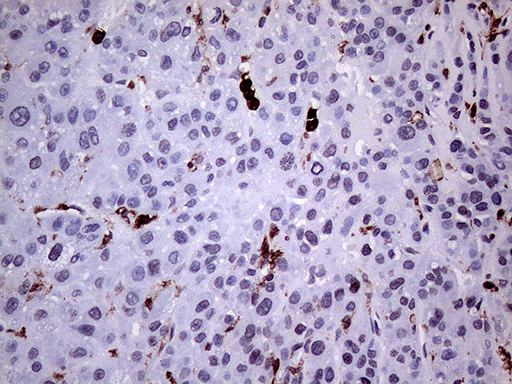 CD45 / LCA Antibody - Immunohistochemical staining of paraffin-embedded Human liver tissue using anti-CD45RO mouse monoclonal antibody. (Heat-induced epitope retrieval by 1mM EDTA in 10mM Tris buffer. (pH8.0) at 120°C for 3 min). (1:1000)