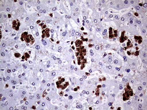 CD45 / LCA Antibody - Immunohistochemical staining of paraffin-embedded Carcinoma of Human liver tissue using anti-CD45RO mouse monoclonal antibody. (Heat-induced epitope retrieval by 1mM EDTA in 10mM Tris buffer. (pH8.0) at 120°C for 3 min). (1:1000)