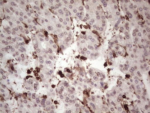 CD45 / LCA Antibody - IHC of paraffin-embedded Carcinoma of Human liver tissue using anti-CD45RO mouse monoclonal antibody. (heat-induced epitope retrieval by 1 mM EDTA in 10mM Tris, pH8.5, 120°C for 3min).