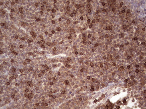 CD45 / LCA Antibody - IHC of paraffin-embedded Human lymphoma tissue using anti-CD45RO mouse monoclonal antibody. (heat-induced epitope retrieval by 1 mM EDTA in 10mM Tris, pH8.5, 120°C for 3min).