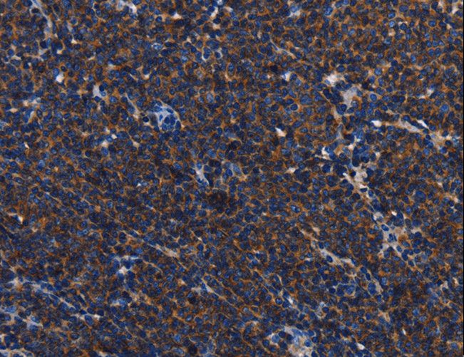 CD45 / LCA Antibody - Immunohistochemistry of paraffin-embedded Human gastric cancer using PTPRC Polyclonal Antibody at dilution of 1:40.
