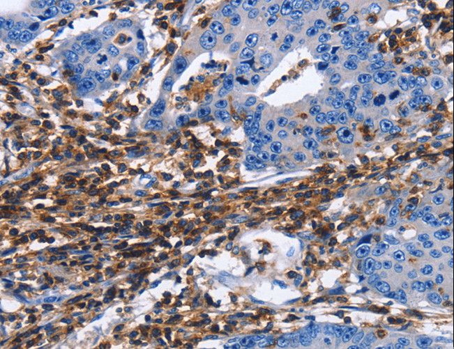 CD45 / LCA Antibody - Immunohistochemistry of paraffin-embedded Human gastric cancer using PTPRC Polyclonal Antibody at dilution of 1:40.