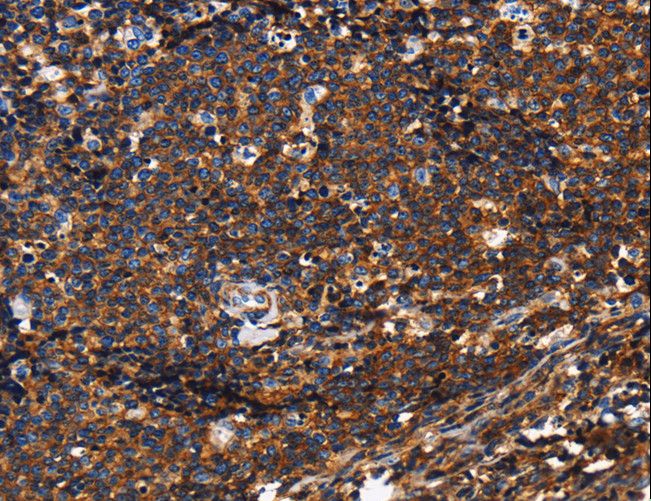 CD45 / LCA Antibody - Immunohistochemistry of paraffin-embedded Human cervical cancer using PTPRC Polyclonal Antibody at dilution of 1:60.
