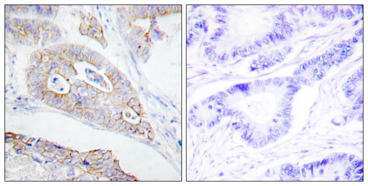 CD45 / LCA Antibody - Peptide - + Immunohistochemistry analysis of paraffin-embedded human colon carcinoma tissue using CD45 antibody.