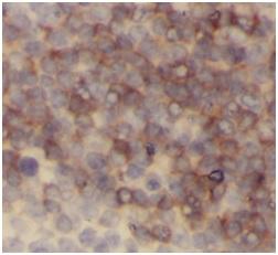 CD45 / LCA Antibody - Immunohistochemistry of paraffin-embedded human tonsillitis tissue slide using CD45 antibody at dilution of 1:300. Heat mediated antigen retrieved with Tris-EDTA buffer (pH9).