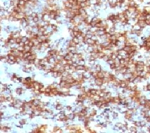 CD45RB Antibody - IHC testing of CD45RB antibody and FFPE human lymphoma (clone CDLA45RB-1).  This image was taken for the unmodified form of this product. Other forms have not been tested.