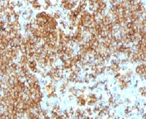 CD45RB Antibody - IHC testing of CD45RB antibody and FFPE human lymphoma (PTPRC/1132).  This image was taken for the unmodified form of this product. Other forms have not been tested.