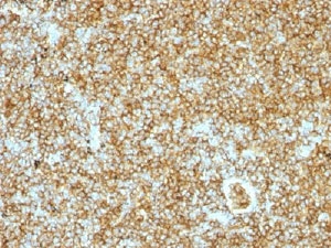 CD45RB Antibody - IHC testing of CD45RB antibody and FFPE human lymphoma.  This image was taken for the unmodified form of this product. Other forms have not been tested.