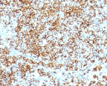 CD45RB Antibody - Formalin-fixed, paraffin-embedded human lymphoma stained with anti-CD45RB antibody (SPM569).  This image was taken for the unmodified form of this product. Other forms have not been tested.