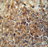 CD46 Antibody - CD46 Antibody immunohistochemistry of formalin-fixed and paraffin-embedded human hepatocarcinoma followed by peroxidase-conjugated secondary antibody and DAB staining.