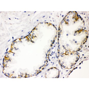 CD46 Antibody - CD46 antibody IHC-paraffin. IHC(P): Human Prostatic Cancer Tissue.