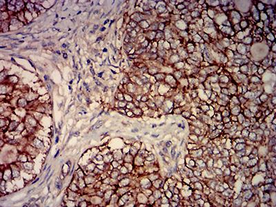 CD46 Antibody - Immunohistochemical analysis of paraffin-embedded cervical cancer tissues using CD46 mouse mAb with DAB staining.