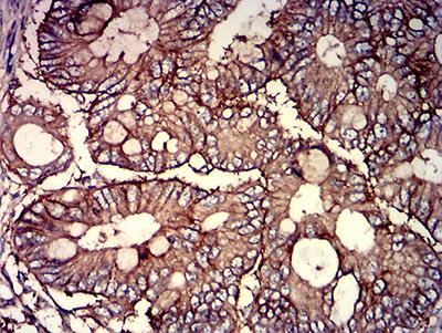 CD46 Antibody - Immunohistochemical analysis of paraffin-embedded rectum cancer tissues using CD46 mouse mAb with DAB staining.