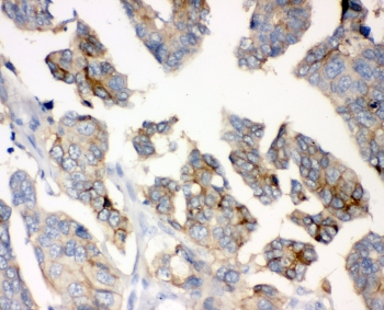 CD47 Antibody - IHC staining of FFPE human ovarian cancer with CD47 antibody at 1ug/ml. HIER: boil tissue sections in pH6, 10mM citrate buffer, for 10-20 min and allow to cool before testing.
