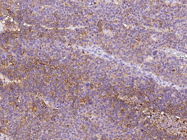CD47 Antibody - Immunochemical staining CD47 in human ovarian cancer with rabbit polyclonal antibody at 1:1000 dilution, formalin-fixed paraffin embedded sections.