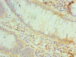CD48 Antibody - Immunohistochemistry of paraffin-embedded human colon cancer using CD48 Antibody at dilution of 1:100