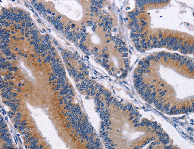 CD48 Antibody - Immunohistochemistry of paraffin-embedded Human colon cancer using CD48 Polyclonal Antibody at dilution of 1:40.