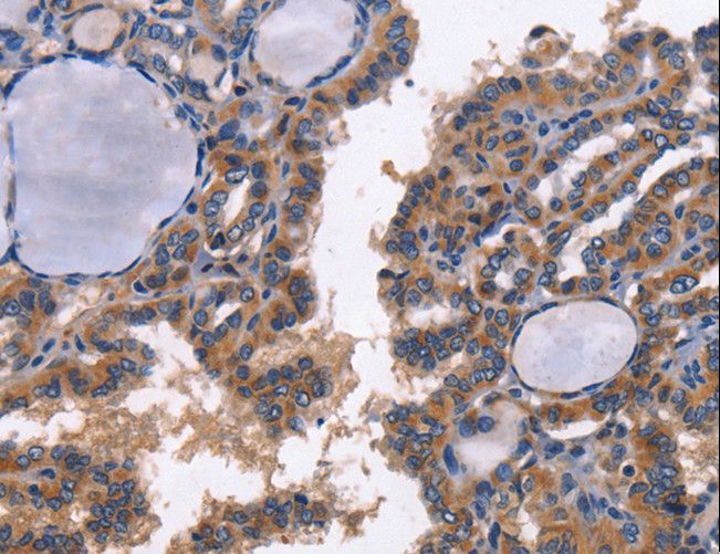 CD48 Antibody - Immunohistochemistry of paraffin-embedded Human thyroid cancer using CD48 Polyclonal Antibody at dilution of 1:40.