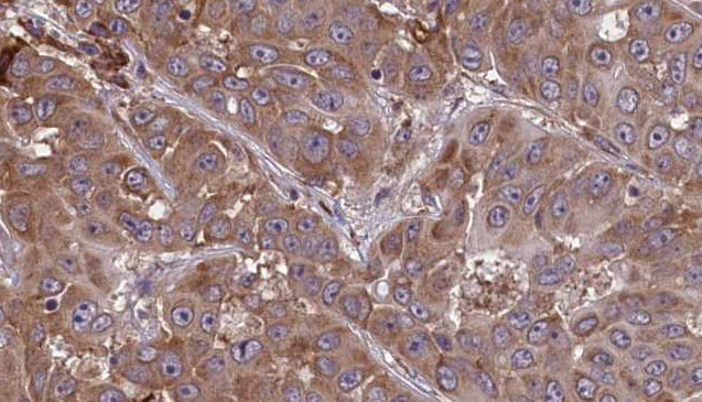 CD48 Antibody - 1:100 staining human liver carcinoma tissues by IHC-P. The sample was formaldehyde fixed and a heat mediated antigen retrieval step in citrate buffer was performed. The sample was then blocked and incubated with the antibody for 1.5 hours at 22°C. An HRP conjugated goat anti-rabbit antibody was used as the secondary.