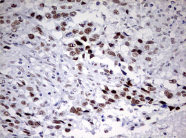 CD5 Antibody - IHC of paraffin-embedded Adenocarcinoma of Human ovary tissue using anti-CD5 mouse monoclonal antibody. (Heat-induced epitope retrieval by 10mM citric buffer, pH6.0, 120°C for 3min).