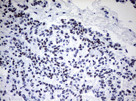 CD5 Antibody - IHC of paraffin-embedded Carcinoma of Human pancreas tissue using anti-CD5 mouse monoclonal antibody. (Heat-induced epitope retrieval by 10mM citric buffer, pH6.0, 120°C for 3min).
