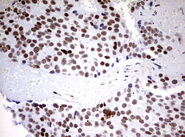 CD5 Antibody - IHC of paraffin-embedded Adenocarcinoma of Human breast tissue using anti-CD5 mouse monoclonal antibody. (Heat-induced epitope retrieval by 10mM citric buffer, pH6.0, 120°C for 3min).