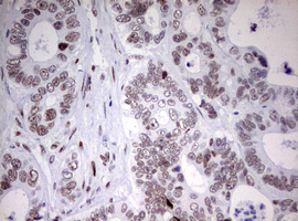 CD5 Antibody - IHC of paraffin-embedded Adenocarcinoma of Human colon tissue using anti-CD5 mouse monoclonal antibody. (Heat-induced epitope retrieval by 10mM citric buffer, pH6.0, 120°C for 3min).