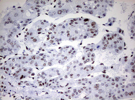 CD5 Antibody - IHC of paraffin-embedded Carcinoma of Human liver tissue using anti-CD5 mouse monoclonal antibody. (Heat-induced epitope retrieval by 10mM citric buffer, pH6.0, 120°C for 3min).