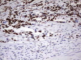 CD5 Antibody - IHC of paraffin-embedded Adenocarcinoma of Human endometrium tissue using anti-CD5 mouse monoclonal antibody. (Heat-induced epitope retrieval by 10mM citric buffer, pH6.0, 120°C for 3min).