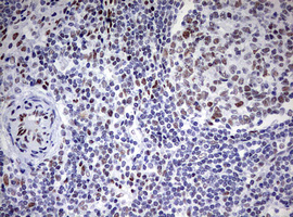 CD5 Antibody - IHC of paraffin-embedded Carcinoma of Human bladder tissue using anti-CD5 mouse monoclonal antibody. (Heat-induced epitope retrieval by 10mM citric buffer, pH6.0, 120°C for 3min).