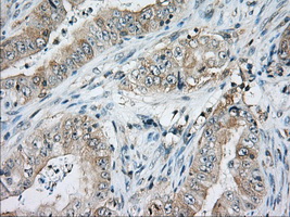 CD5 Antibody - Immunohistochemical staining of paraffin-embedded Adenocarcinoma of Human colon tissue using anti-CD5 mouse monoclonal antibody. (Dilution 1:50).