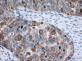 CD5 Antibody - Immunohistochemical staining of paraffin-embedded Adenocarcinoma of Human ovary tissue using anti-CD5 mouse monoclonal antibody. (Dilution 1:50).