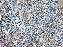 CD5 Antibody - Immunohistochemical staining of paraffin-embedded Carcinoma of Human thyroid tissue using anti-CD5 mouse monoclonal antibody. (Dilution 1:50).