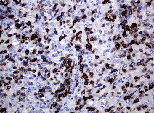 CD5 Antibody - Immunohistochemical staining of paraffin-embedded Human lymphoma tissue using anti-CD5 mouse monoclonal antibody. (Clone UMAB9, dilution 1:100; heat-induced epitope retrieval by 10mM citric buffer, pH6.0, 120C for 3min)