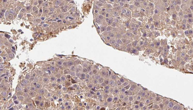 CD52 Antibody - 1:100 staining human liver carcinoma tissues by IHC-P. The sample was formaldehyde fixed and a heat mediated antigen retrieval step in citrate buffer was performed. The sample was then blocked and incubated with the antibody for 1.5 hours at 22°C. An HRP conjugated goat anti-rabbit antibody was used as the secondary.
