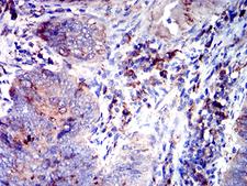CD53 Antibody - Immunohistochemical analysis of paraffin-embedded rectum cancer tissues using CD53 mouse mAb with DAB staining.