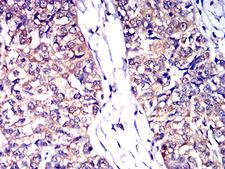 CD53 Antibody - Immunohistochemical analysis of paraffin-embedded bladder cancer tissues using CD53 mouse mAb with DAB staining.