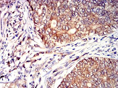 CD53 Antibody - Immunohistochemical analysis of paraffin-embedded cervical cancer tissues using CD53 mouse mAb with DAB staining.