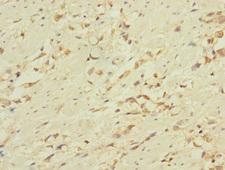CD53 Antibody - Immunohistochemistry of paraffin-embedded human gastric cancer at dilution 1:100