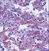 CD55 Antibody - CD55 Antibody immunohistochemistry of formalin-fixed and paraffin-embedded human lung adenocarcinoma followed by peroxidase-conjugated secondary antibody and DAB staining.