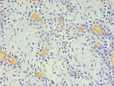 CD59 Antibody - Immunohistochemical of paraffin-embedded Human breast cancer using CD59 Monoclonal Antibody (2E11-2B5) at dilution of 1:200.