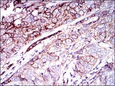 CD59 Antibody - IHC of paraffin-embedded bladder cancer tissues using CD59 mouse monoclonal antibody with DAB staining.