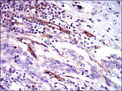 CD59 Antibody - IHC of paraffin-embedded esophageal cancer tissues using CD59 mouse monoclonal antibody with DAB staining.