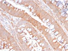 CD59 Antibody - Formalin-fixed, paraffin-embedded human Colon Carcinoma stained with CD59 Rabbit Recombinant Monoclonal Antibody (MACIF/2867R).