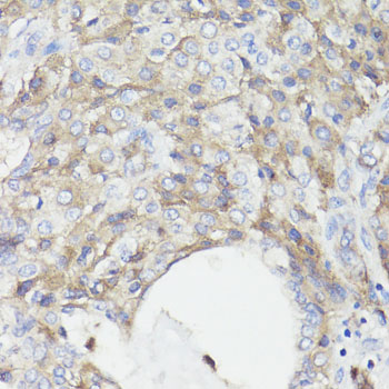 CD59 Antibody - Immunohistochemistry of paraffin-embedded human lung cancer using CD59 antibodyat dilution of 1:100 (40x lens).