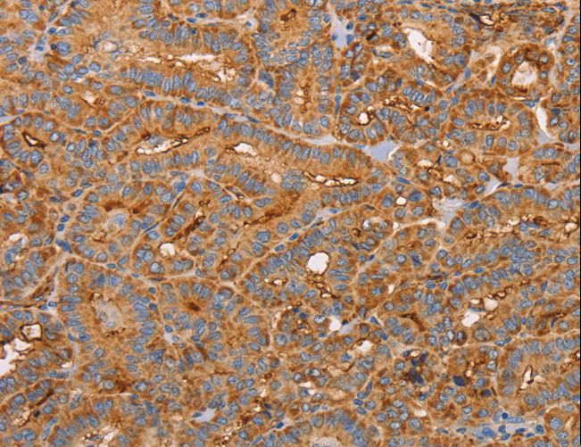 CD59 Antibody - Immunohistochemistry of paraffin-embedded Human thyroid cancer using CD59 Polyclonal Antibody at dilution of 1:50.