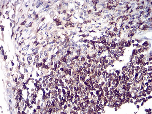 CD6 Antibody - Immunohistochemical analysis of paraffin-embedded tissues using breast cancer mouse mAb with DAB staining.