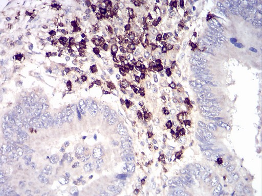 CD6 Antibody - Immunohistochemical analysis of paraffin-embedded rectum cancer tissues using rectum cancer mouse mAb with DAB staining.